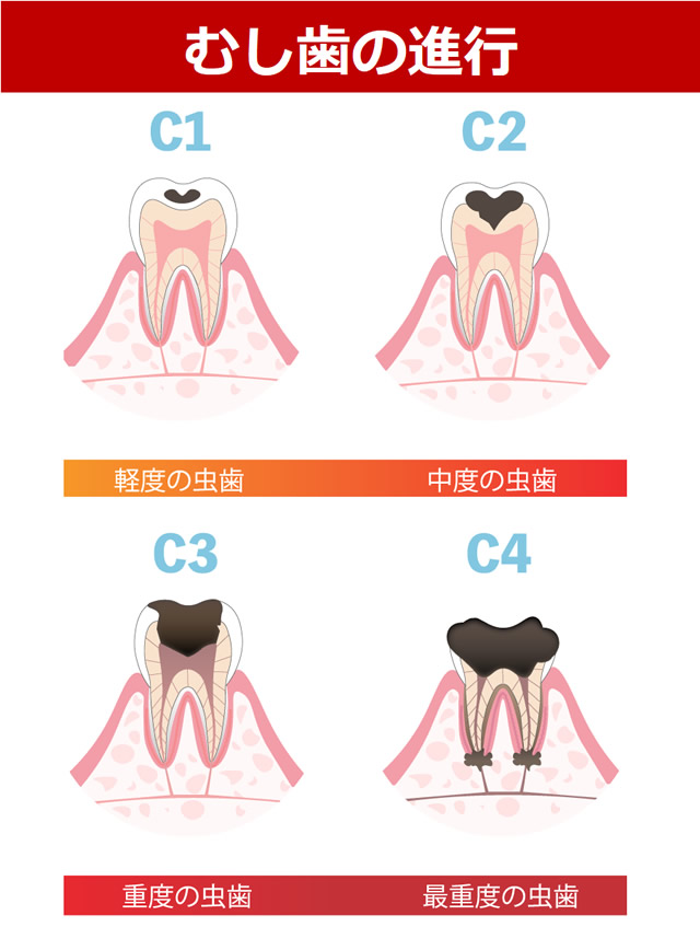 むし歯