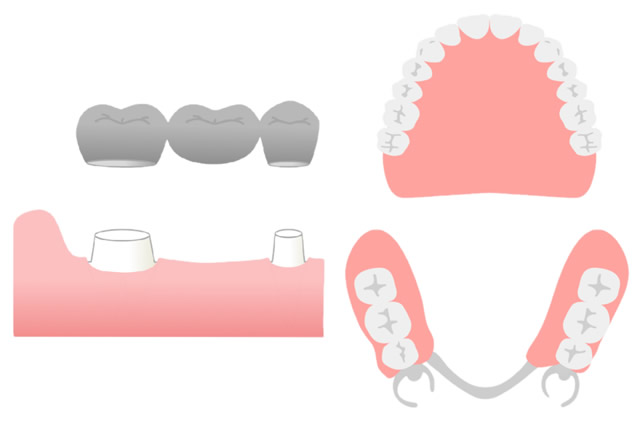入れ歯・ブリッジ