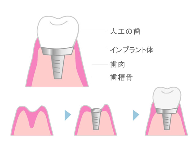 インプラント