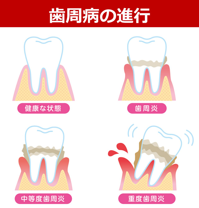 歯周病とは？