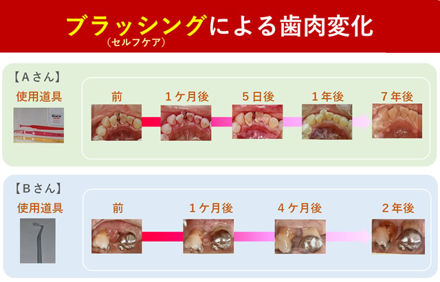 ブラッシングで治るの？