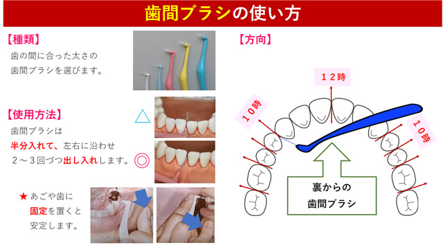 正しい歯間ブラシは？